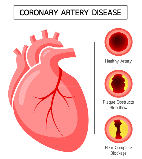 Coronary Artery Disease