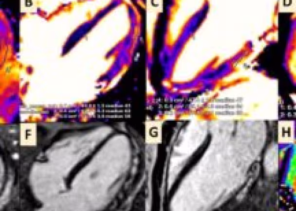 COVID19-and-Myocarditis-Publication-Imagery_MHIF-216x216.jpeg
