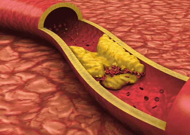 blocked artery