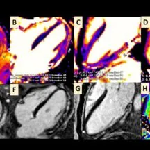 COVID19-and-Myocarditis-Publication-Imagery_MHIF-216x216.jpeg