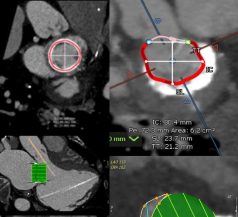 Training Professionals Across the Globe in the Latest Techniques for Cardiovascular Imaging and Transcatheter Mitral Valve Replacement